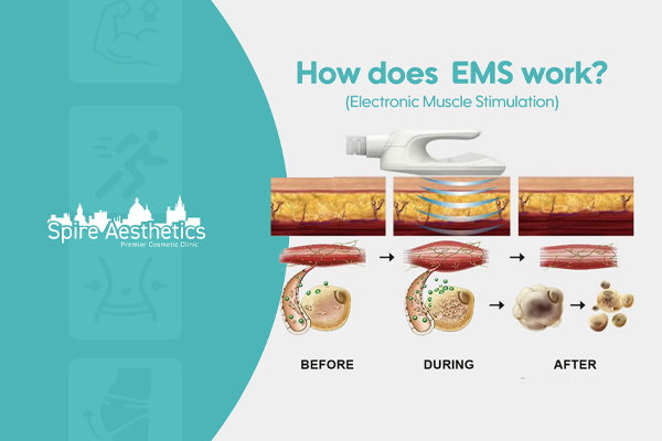 EMS treatment for post pregnancy weight loss treatment Iver