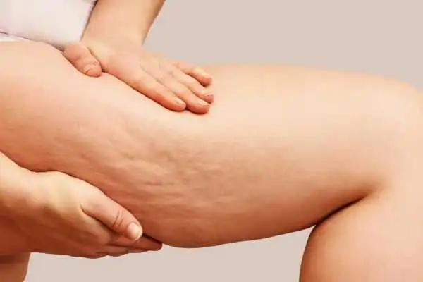 Image of woman showing leg with cellulite Iver