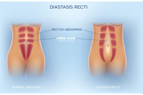 What Non-Surgical Options Are Available for Diastasis Recti Iver?