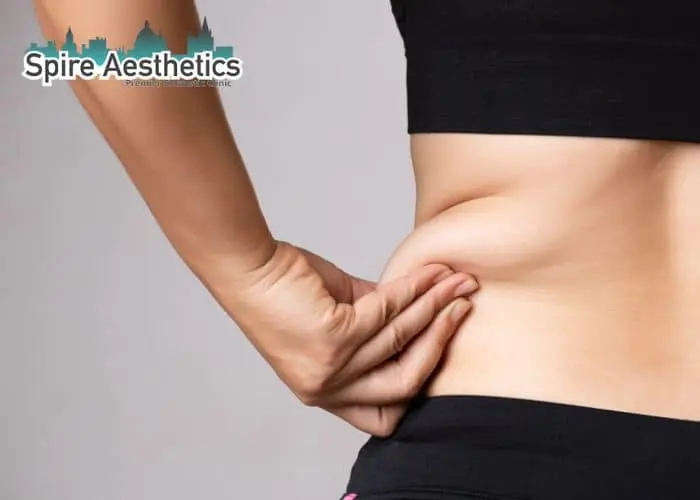 Image of woman pinching fat on their hips Iver. Fat Freezing treatment 