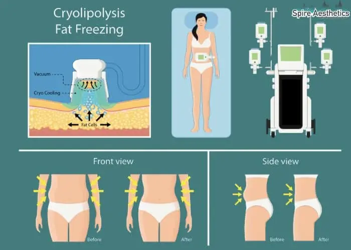 Fat freezing treatment Iver benefits for competitions to remove stubborn fat deposits.