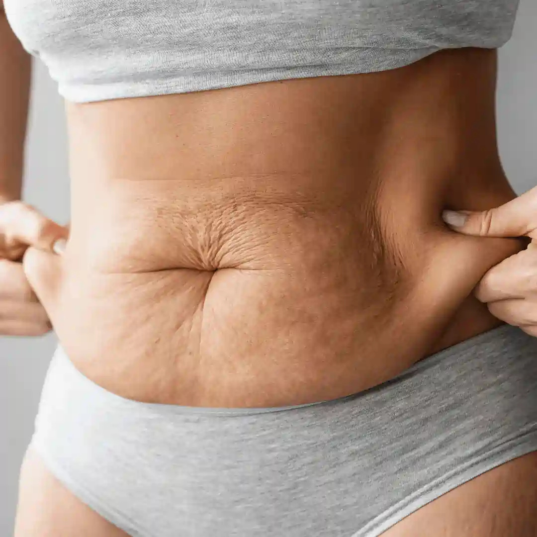 Is It Normal to Have Loose Skin After Pregnancy Iver?