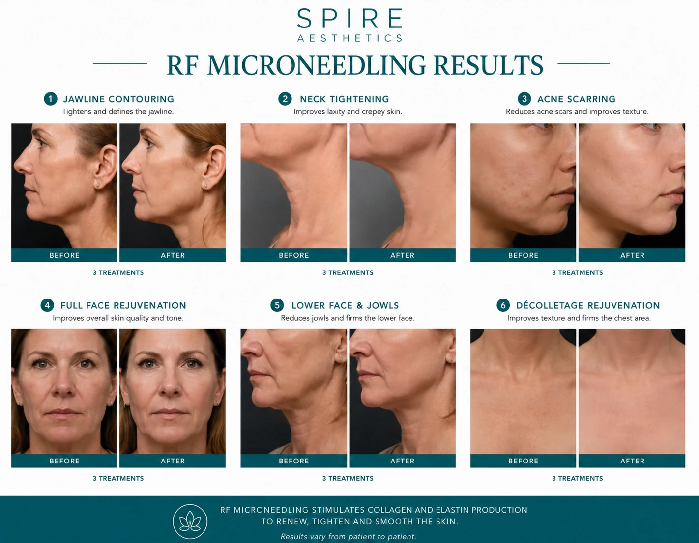 RF Microneedling Skin tightening Iver results