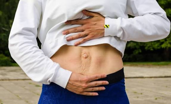 When Could Diastasis Recti Be the Missing Piece of the Puzzle Iver?