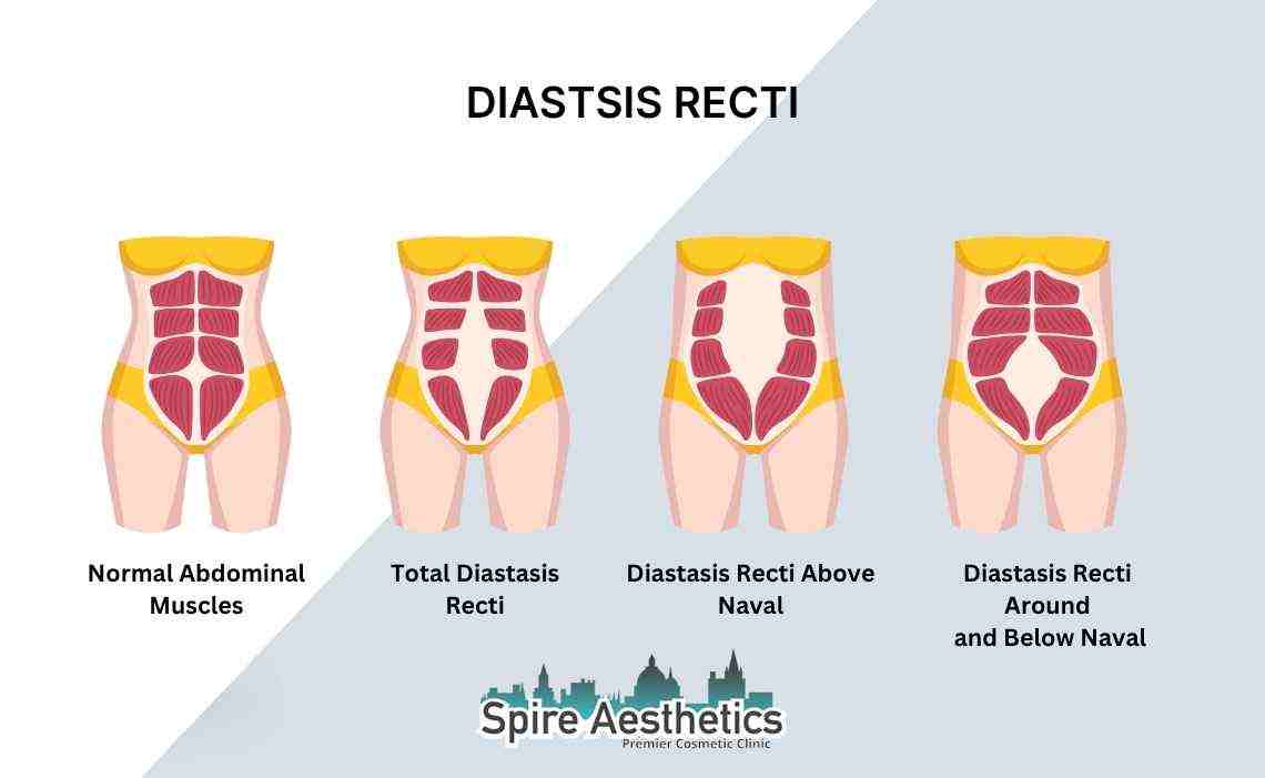 Is Non-Surgical Diastasis Recti Treatment Right for You? Common Concerns Answered Iver